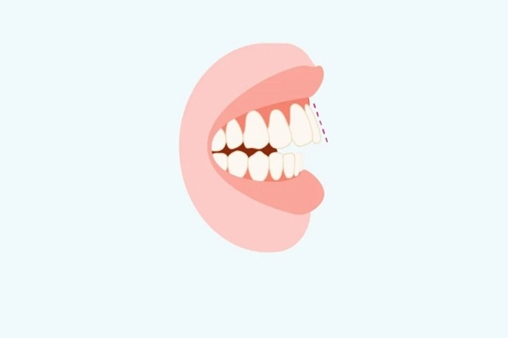 Hô răng là tình trạng hàm răng phía trên bị chìa ra quá mức so với hàm dưới