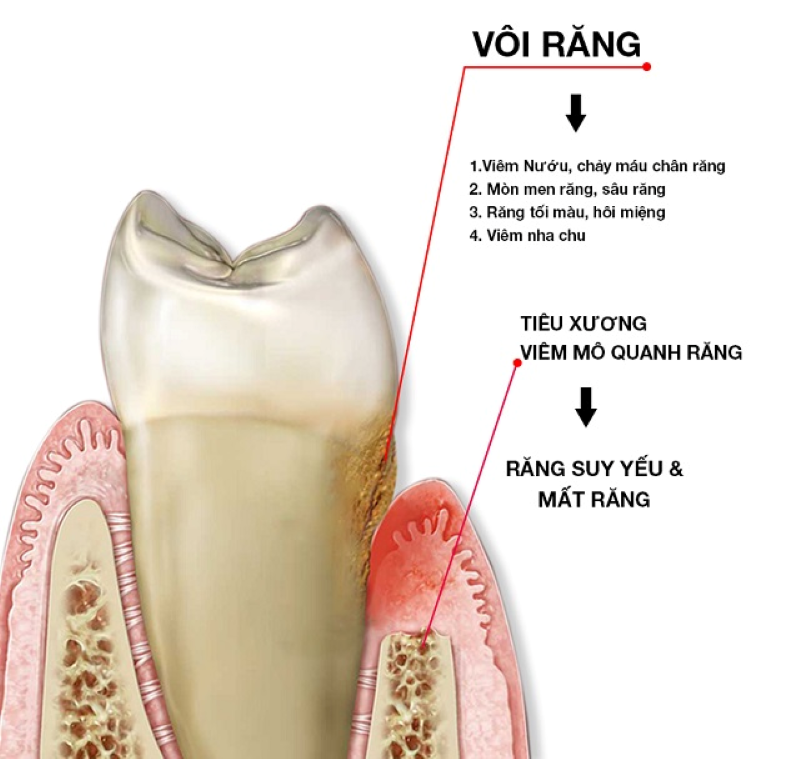 Vôi răng là nguyên nhân chính dẫn đến những bệnh lý răng miệng thường gặp như hôi miệng, viêm nha chu