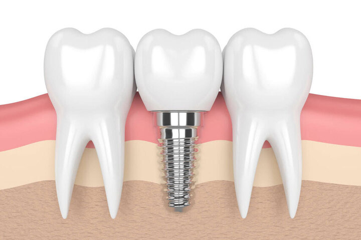 Cấy ghép Implant thực chất là tạo nên một chiếc răng giả thay thế vào vị trí của răng đã mất đi