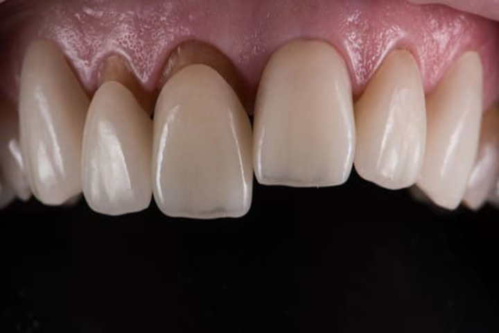 Bọc răng sứ tại địa chỉ kém uy tín có thể bị đau buốt chân răng